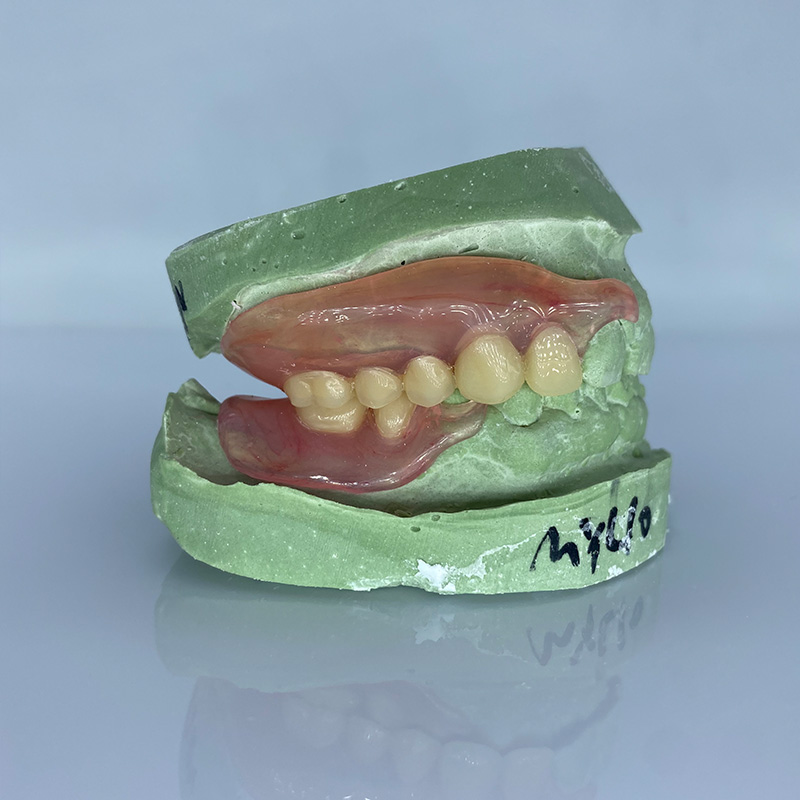 Removable Restoration