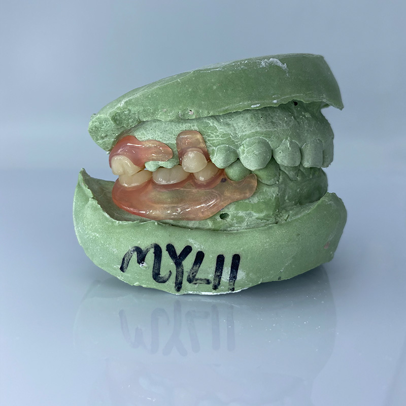 Removable Restoration