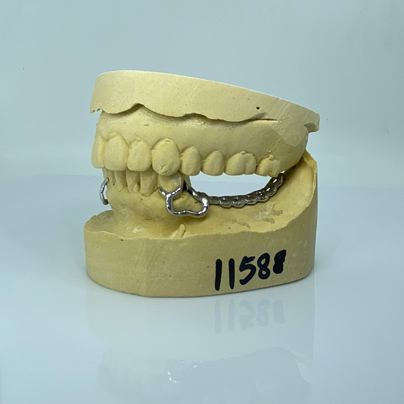 Removable Restoration