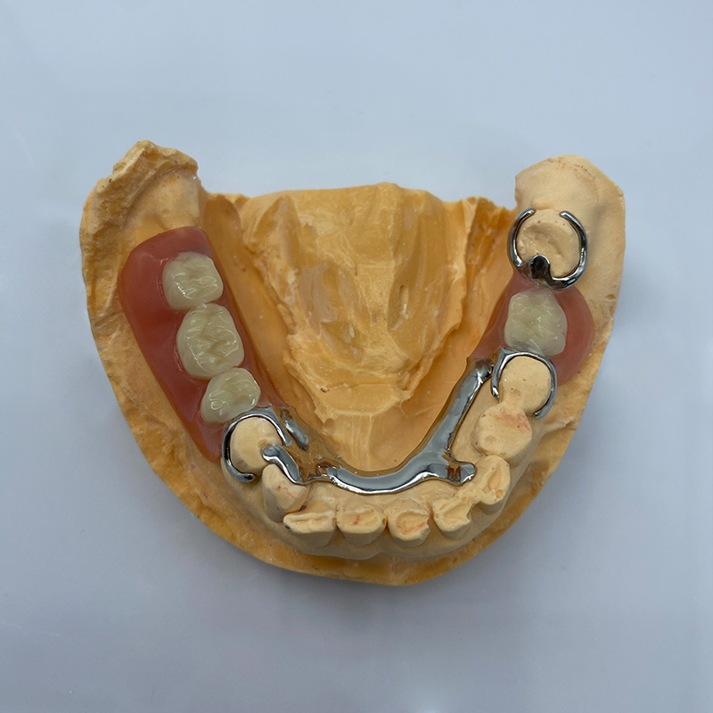 Removable Restoration