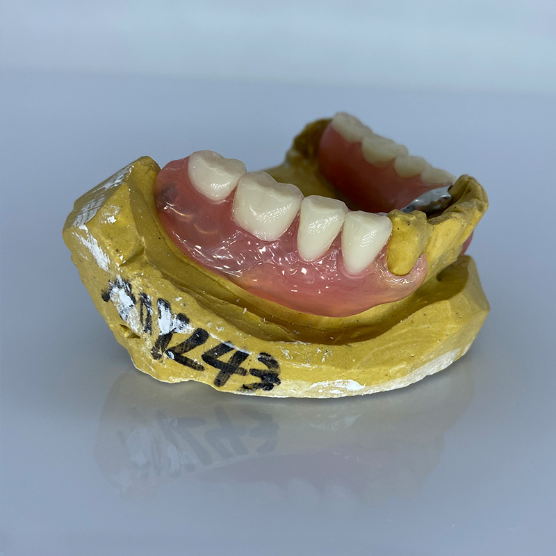 Removable Restoration