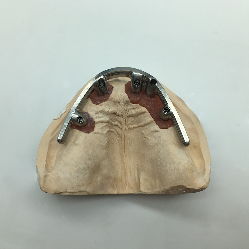 Implant Restoration