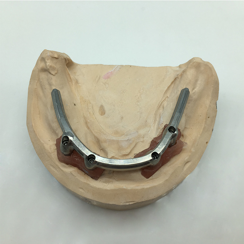 Implant Restoration
