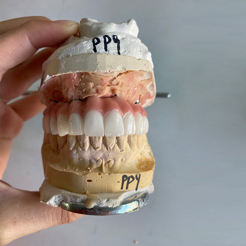 Implant Restoration