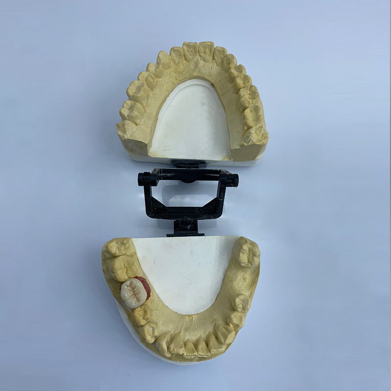 Implant Restoration