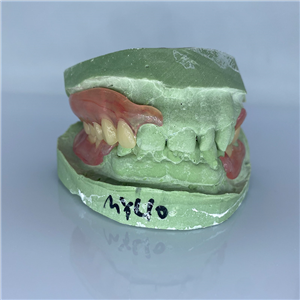 Removable Restoration
