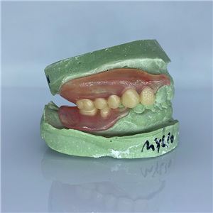 Removable Restoration