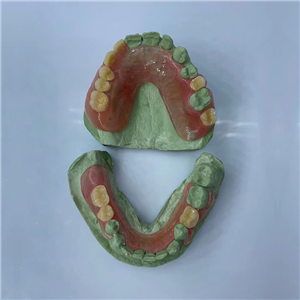 Removable Restoration