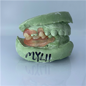 Removable Restoration