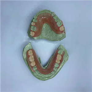 Removable Restoration