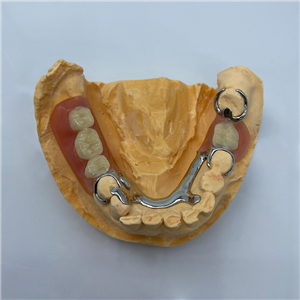 Removable Restoration