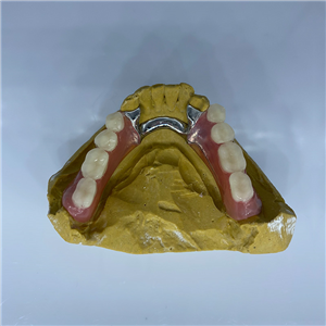 Removable Restoration