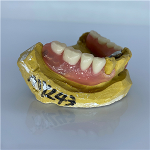 Removable Restoration