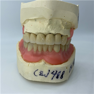 Removable Restoration