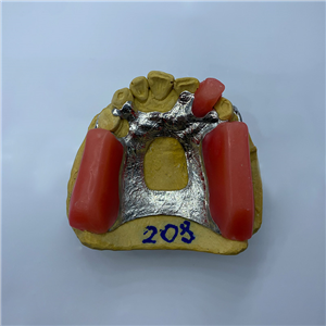 Removable Restoration
