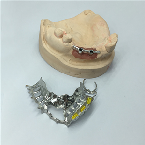 Removable Restoration