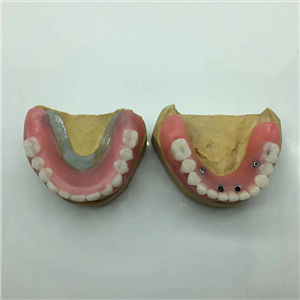 Removable Restoration