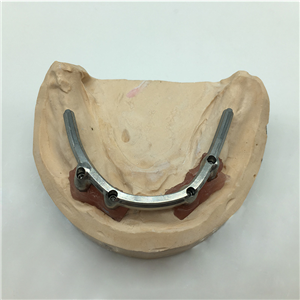 Implant Restoration
