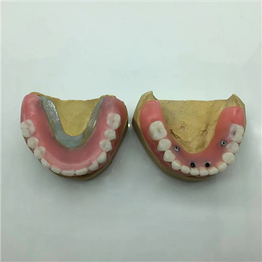 Removable Restoration