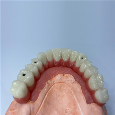 Implant Restoration