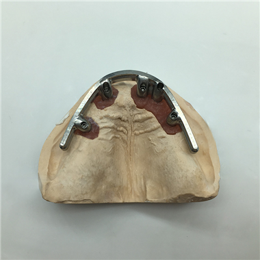 Implant Restoration