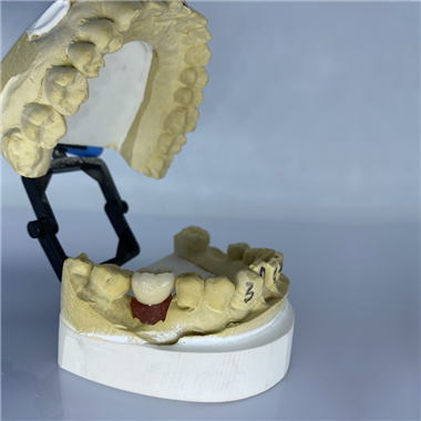 Implant Restoration