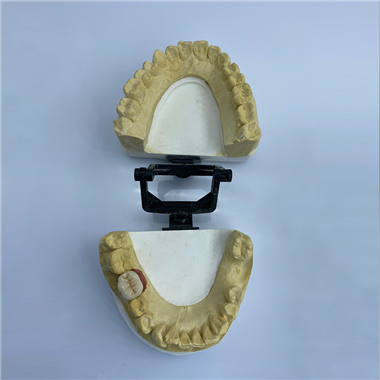 Implant Restoration